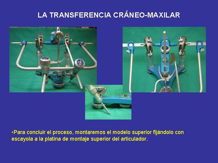 LA TRANSFERENCIA CRÁNEO-MAXILAR • Para concluir el proceso, montaremos el modelo superior fijándolo con