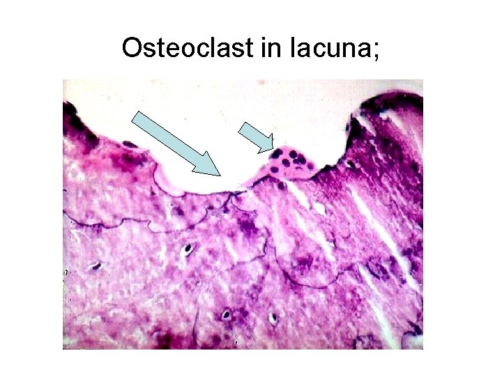 Osteoclast in lacuna; 