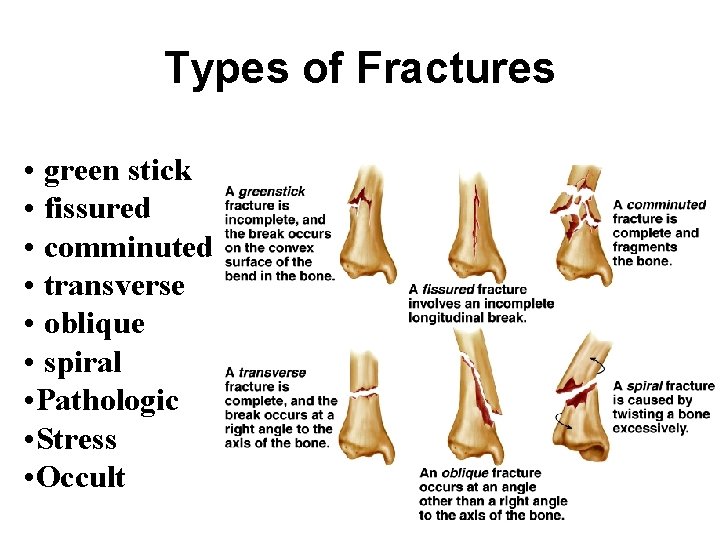 Types of Fractures • green stick • fissured • comminuted • transverse • oblique