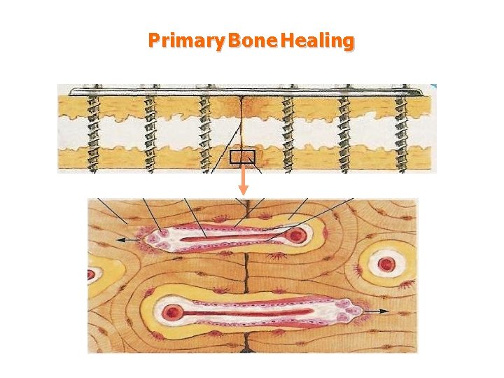 Primary Bone Healing 
