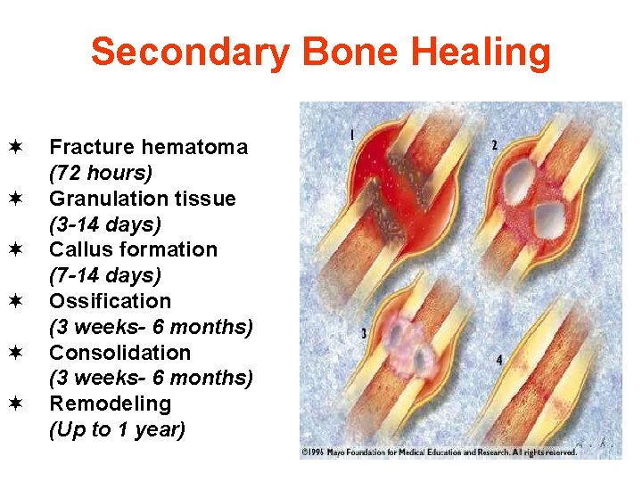 Secondary Bone Healing ¬ ¬ ¬ Fracture hematoma (72 hours) Granulation tissue (3 -14