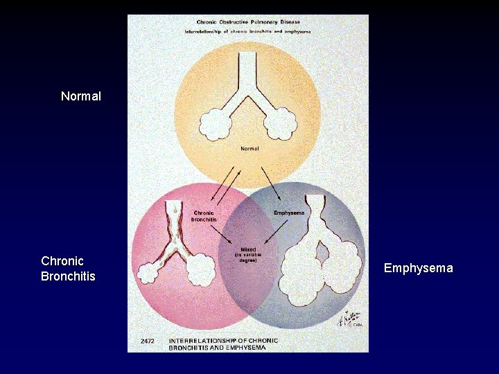 Normal Chronic Bronchitis Emphysema 