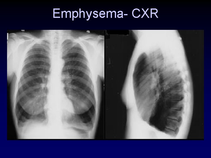Emphysema- CXR 
