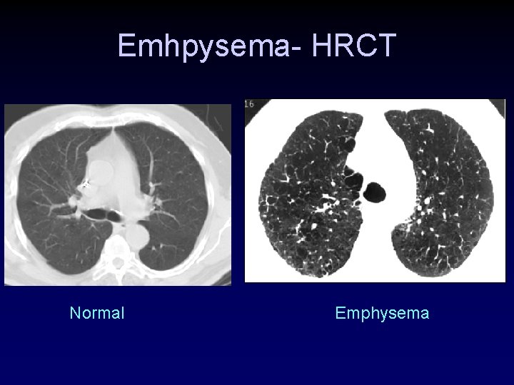 Emhpysema- HRCT Normal Emphysema Emhpysema- HRCT Normal Emphysema