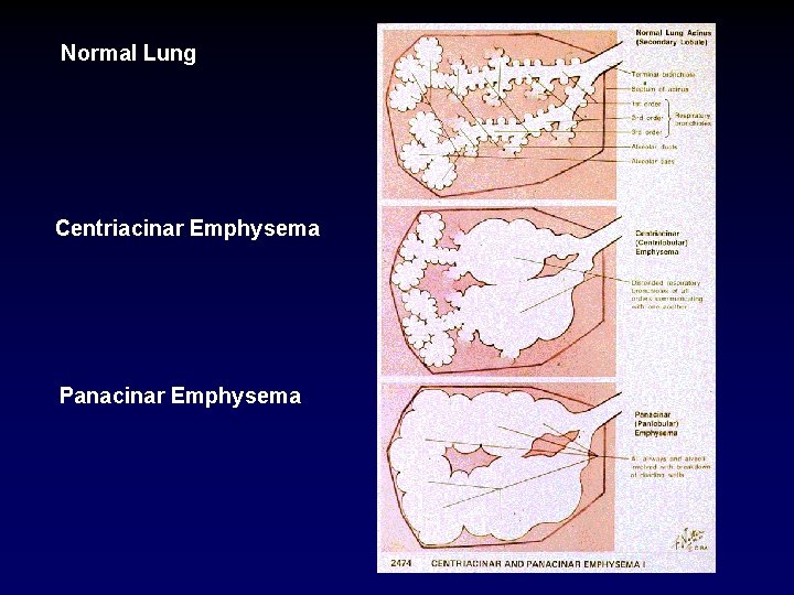 Normal Lung Centriacinar Emphysema Panacinar Emphysema 