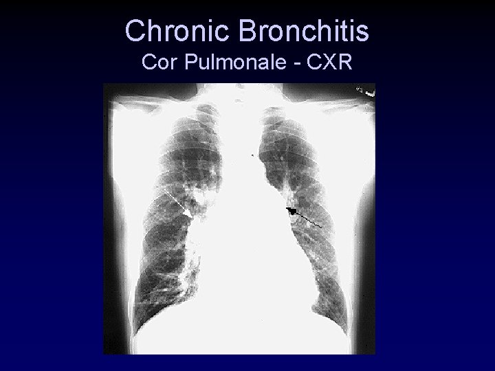 Chronic Bronchitis Cor Pulmonale - CXR 