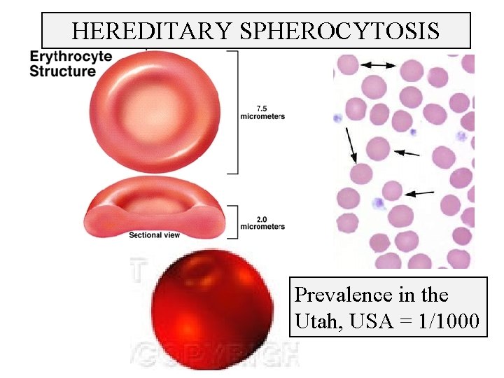 HEREDITARY SPHEROCYTOSIS Spherocyte Prevalence in the Utah, USA = 1/1000 