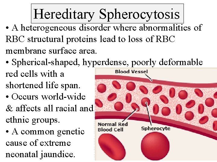 Hereditary Spherocytosis • A heterogeneous disorder where abnormalities of RBC structural proteins lead to