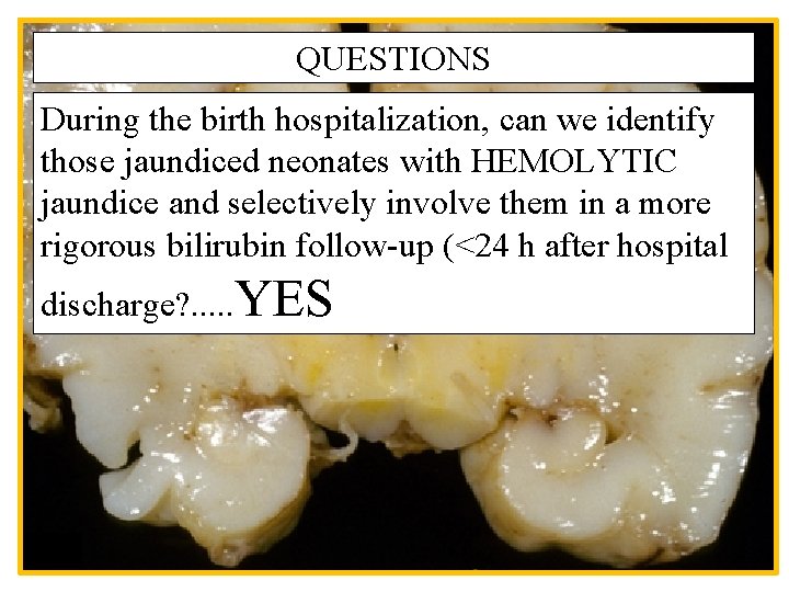 QUESTIONS During the birth hospitalization, can we identify those jaundiced neonates with HEMOLYTIC jaundice