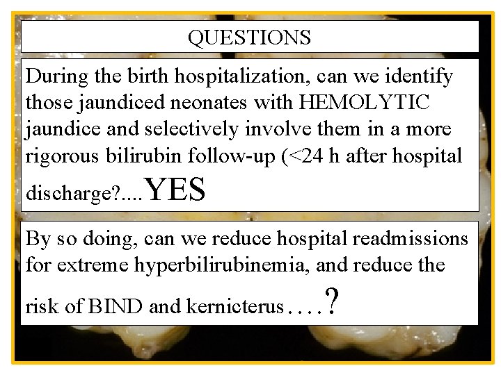 QUESTIONS During the birth hospitalization, can we identify those jaundiced neonates with HEMOLYTIC jaundice