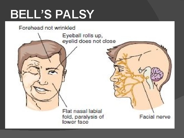 BELL’S PALSY 