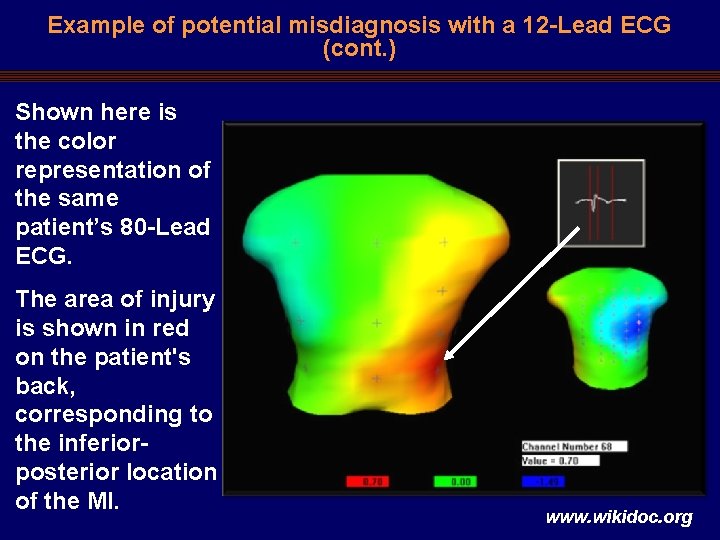 Example of potential misdiagnosis with a 12 -Lead ECG (cont. ) Shown here is