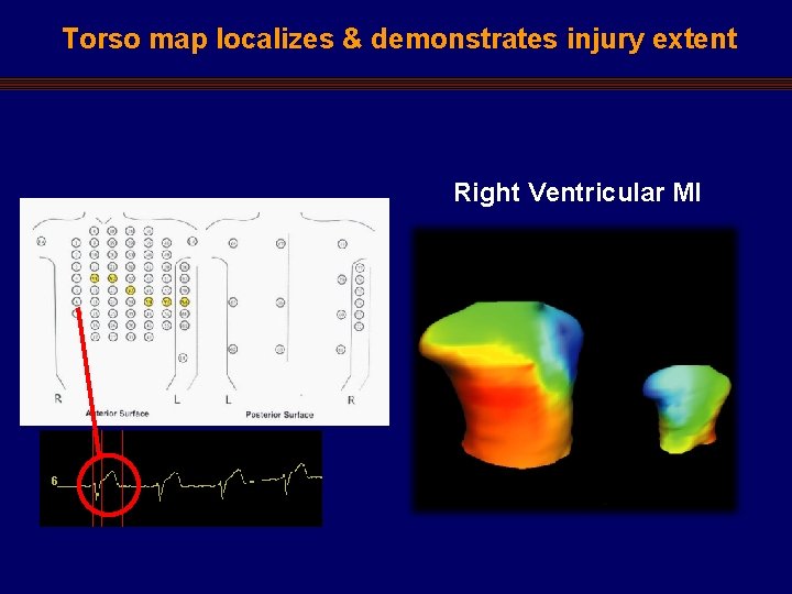 Torso map localizes & demonstrates injury extent Right Ventricular MI 