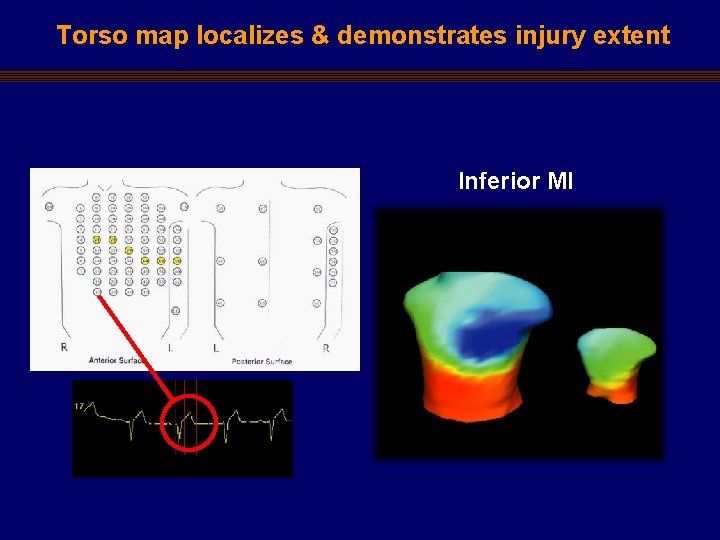 Torso map localizes & demonstrates injury extent Inferior MI 