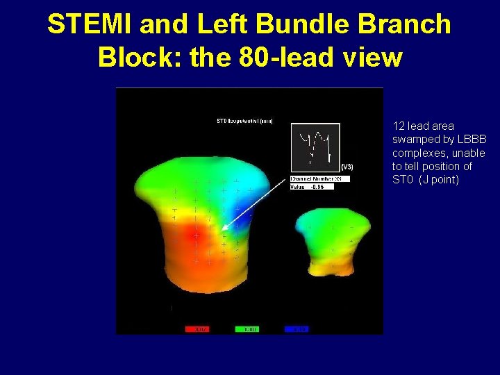 STEMI and Left Bundle Branch Block: the 80 -lead view 12 lead area swamped