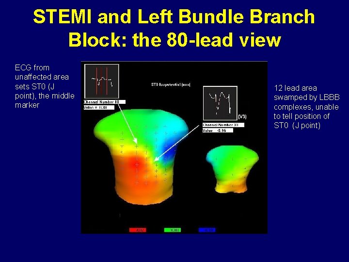 STEMI and Left Bundle Branch Block: the 80 -lead view ECG from unaffected area