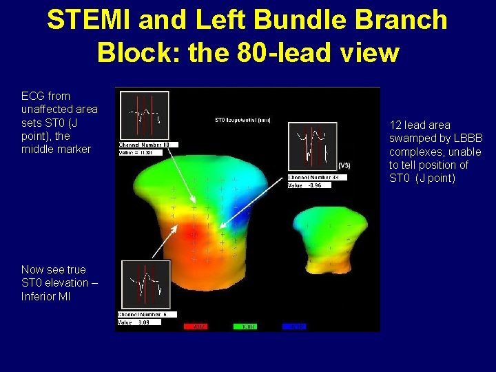 STEMI and Left Bundle Branch Block: the 80 -lead view ECG from unaffected area