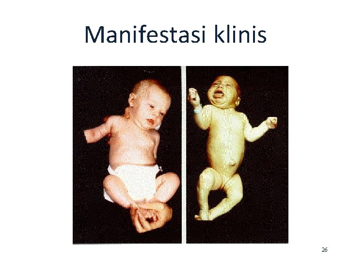 Manifestasi klinis 26 