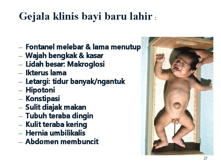 Gejala klinis bayi baru lahir : – – – Fontanel melebar & lama menutup