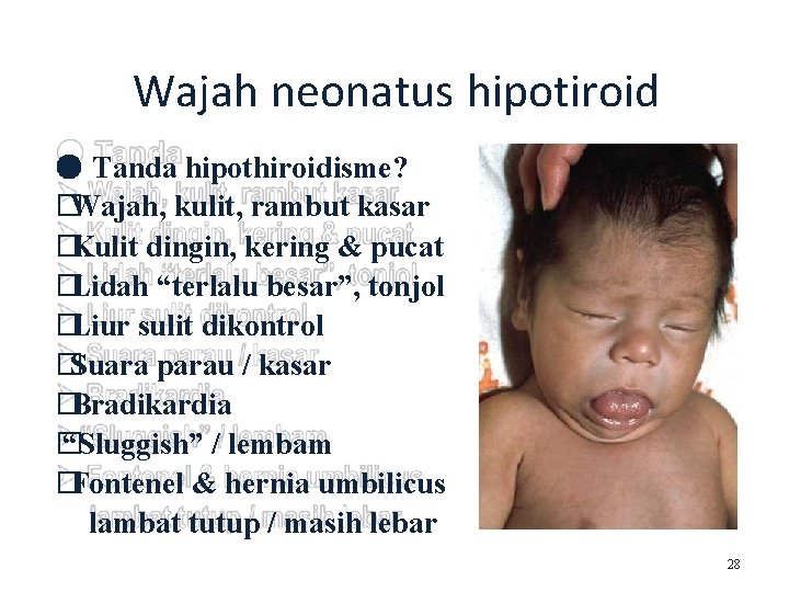Wajah neonatus hipotiroid ● Tanda hipothiroidisme? �Wajah, kulit, rambut kasar �Kulit dingin, kering &