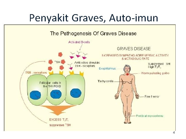 Penyakit Graves, Auto-imun 4 