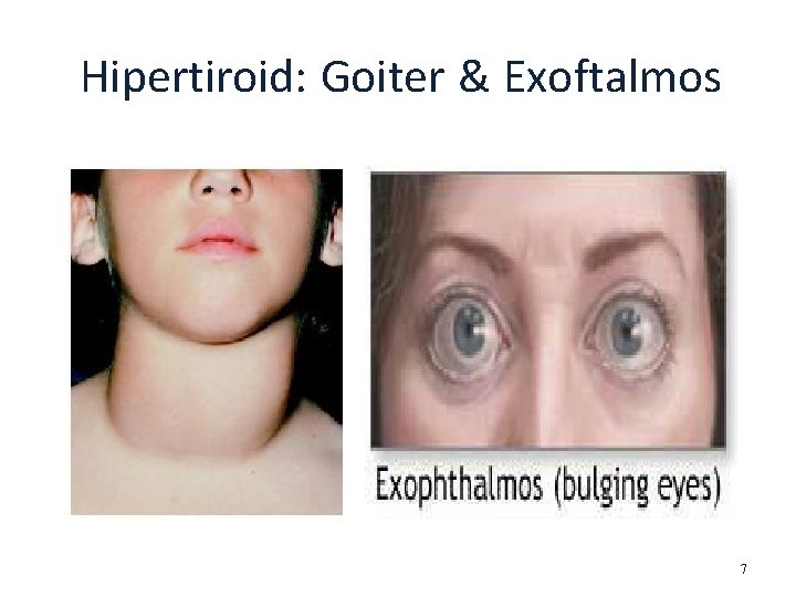 Hipertiroid: Goiter & Exoftalmos 7 
