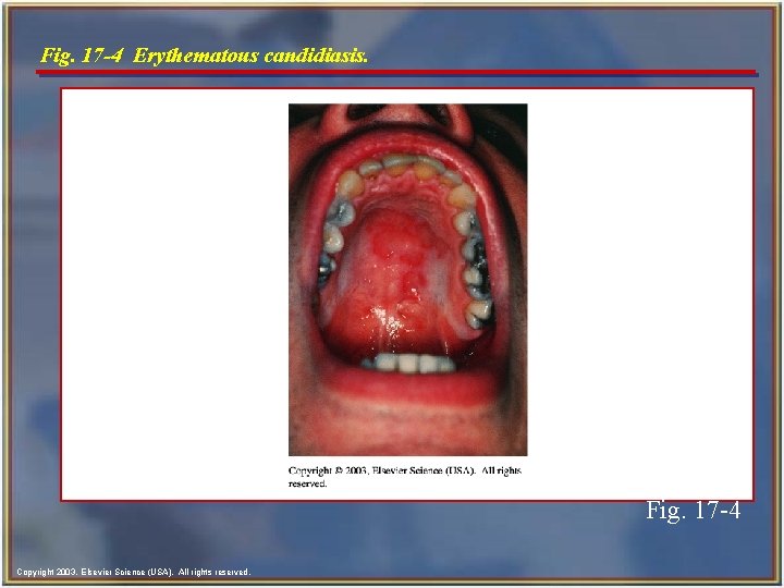 Fig. 17 -4 Erythematous candidiasis. Fig. 17 -4 Copyright 2003, Elsevier Science (USA). All
