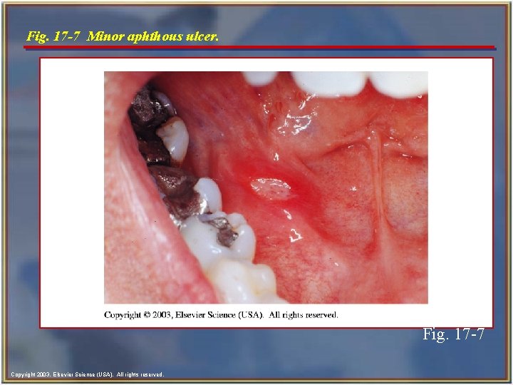 Fig. 17 -7 Minor aphthous ulcer. Fig. 17 -7 Copyright 2003, Elsevier Science (USA).