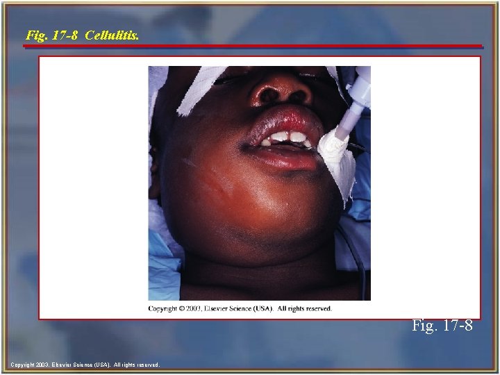 Fig. 17 -8 Cellulitis. Fig. 17 -8 Copyright 2003, Elsevier Science (USA). All rights