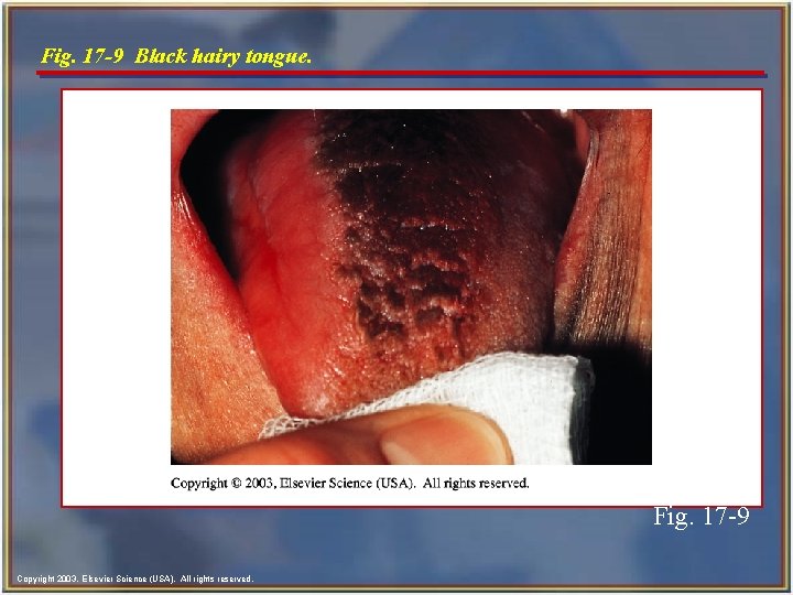 Fig. 17 -9 Black hairy tongue. Fig. 17 -9 Copyright 2003, Elsevier Science (USA).