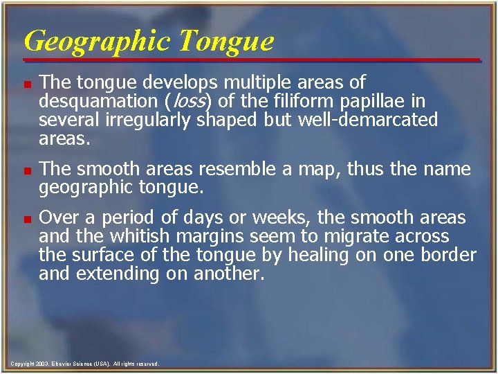 Geographic Tongue n n n The tongue develops multiple areas of desquamation (loss) of