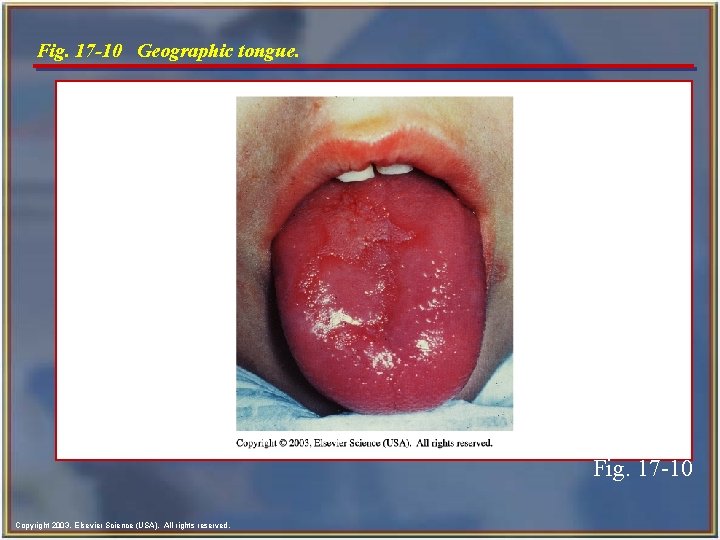 Fig. 17 -10 Geographic tongue. Fig. 17 -10 Copyright 2003, Elsevier Science (USA). All