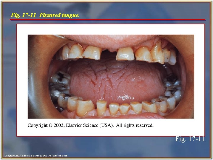 Fig. 17 -11 Fissured tongue. Fig. 17 -11 Copyright 2003, Elsevier Science (USA). All