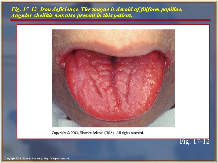 Fig. 17 -12 Iron deficiency. The tongue is devoid of filiform papillae. Angular cheilitis