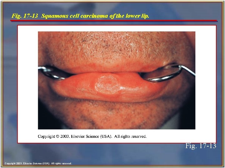 Fig. 17 -13 Squamous cell carcinoma of the lower lip. Fig. 17 -13 Copyright