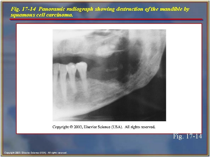 Fig. 17 -14 Panoramic radiograph showing destruction of the mandible by squamous cell carcinoma.