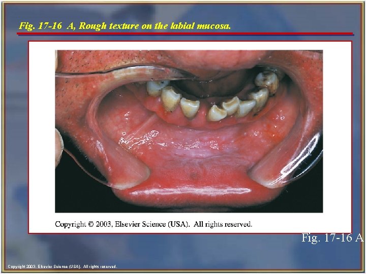 Fig. 17 -16 A, Rough texture on the labial mucosa. Fig. 17 -16 A