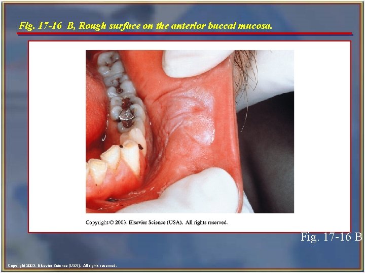 Fig. 17 -16 B, Rough surface on the anterior buccal mucosa. Fig. 17 -16