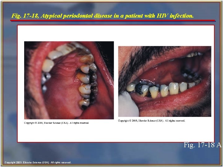 Fig. 17 -18, Atypical periodontal disease in a patient with HIV infection. Fig. 17