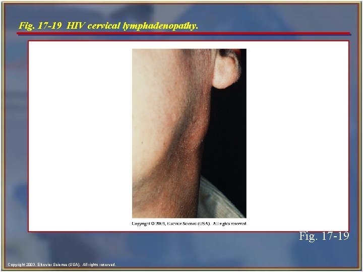 Fig. 17 -19 HIV cervical lymphadenopathy. Fig. 17 -19 Copyright 2003, Elsevier Science (USA).