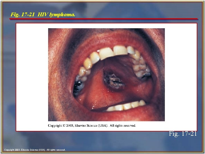 Fig. 17 -21 HIV lymphoma. Fig. 17 -21 Copyright 2003, Elsevier Science (USA). All