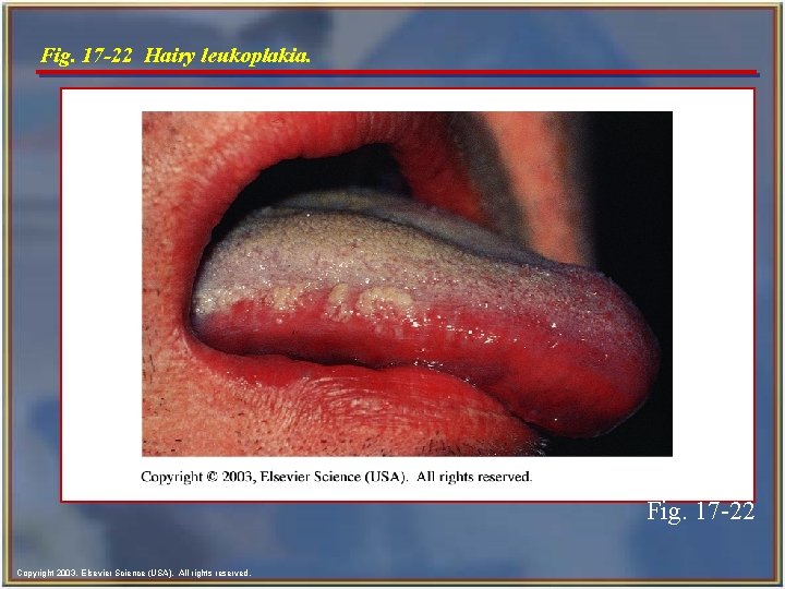 Fig. 17 -22 Hairy leukoplakia. Fig. 17 -22 Copyright 2003, Elsevier Science (USA). All