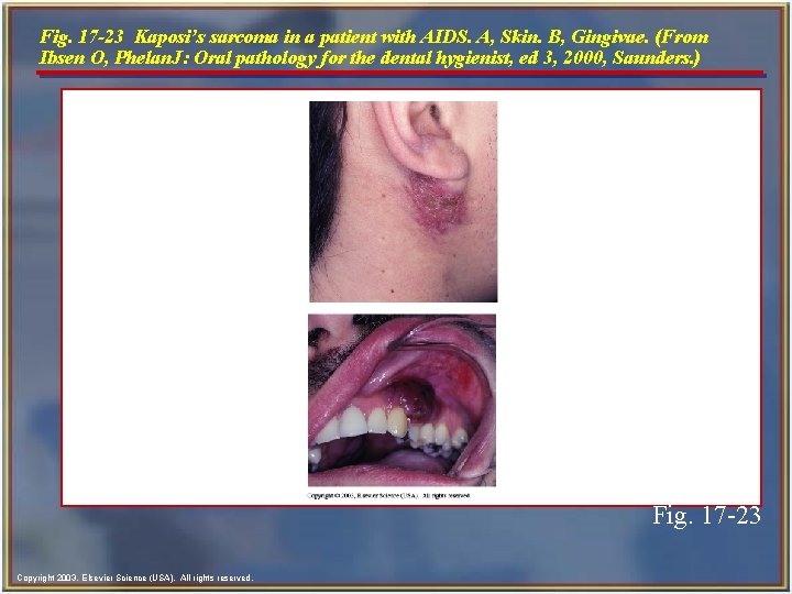 Fig. 17 -23 Kaposi’s sarcoma in a patient with AIDS. A, Skin. B, Gingivae.