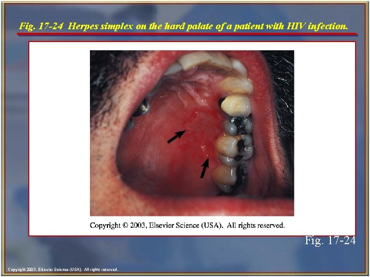 Fig. 17 -24 Herpes simplex on the hard palate of a patient with HIV