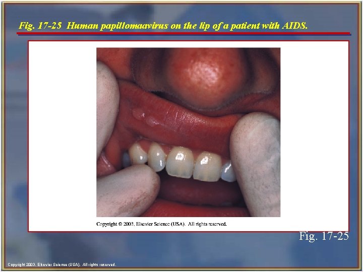 Fig. 17 -25 Human papillomaavirus on the lip of a patient with AIDS. Fig.