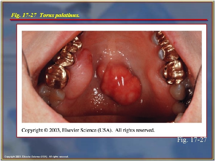 Fig. 17 -27 Torus palatinus. Fig. 17 -27 Copyright 2003, Elsevier Science (USA). All