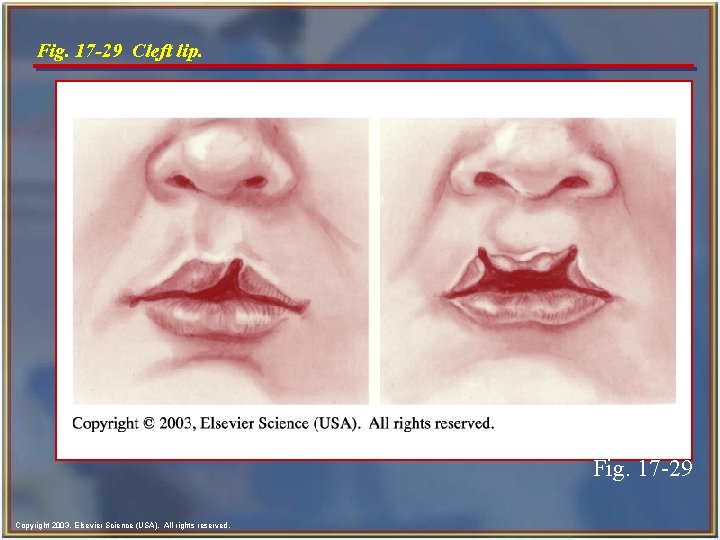 Fig. 17 -29 Cleft lip. Fig. 17 -29 Copyright 2003, Elsevier Science (USA). All