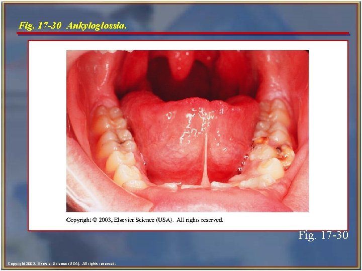 Fig. 17 -30 Ankyloglossia. Fig. 17 -30 Copyright 2003, Elsevier Science (USA). All rights