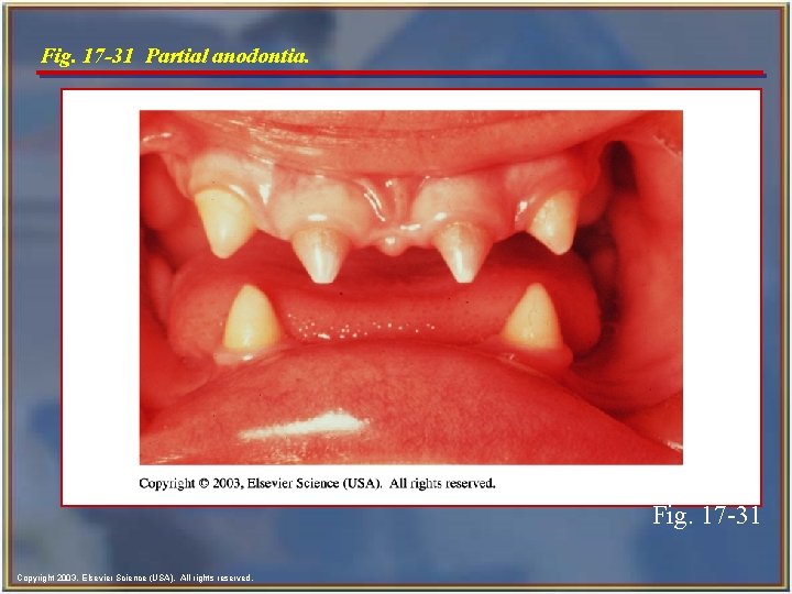 Fig. 17 -31 Partial anodontia. Fig. 17 -31 Copyright 2003, Elsevier Science (USA). All