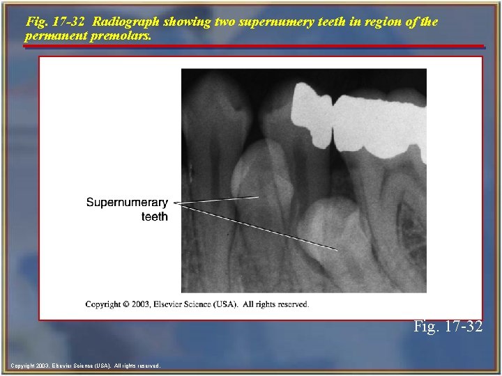 Fig. 17 -32 Radiograph showing two supernumery teeth in region of the permanent premolars.